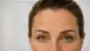 Quando inizia ad agire il botox e quanto dura l'effetto