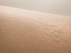 Damaged Skin Barrier: Signs, Causes, and How to Repair It